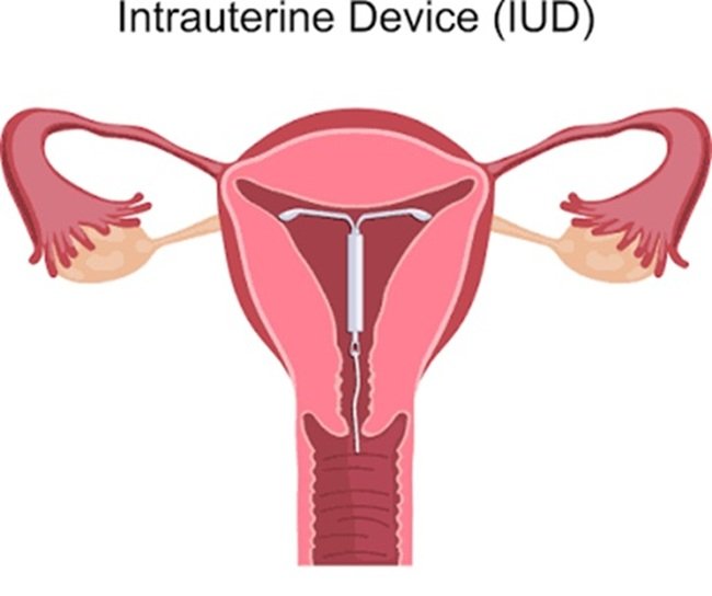 Can IUD change your menstrual cycle? Here’s what we know